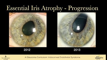ICE - The Iridocorneal Endothelial Syndromes