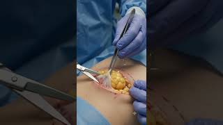 Lipoma excision #mrcs