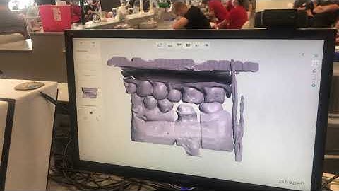 Scanning (3shape Lab Scanner) and Designing (20:45) your crown - Larry Borgeson, Prosth. Engineer