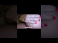 phantompainmasage amputeecommunity