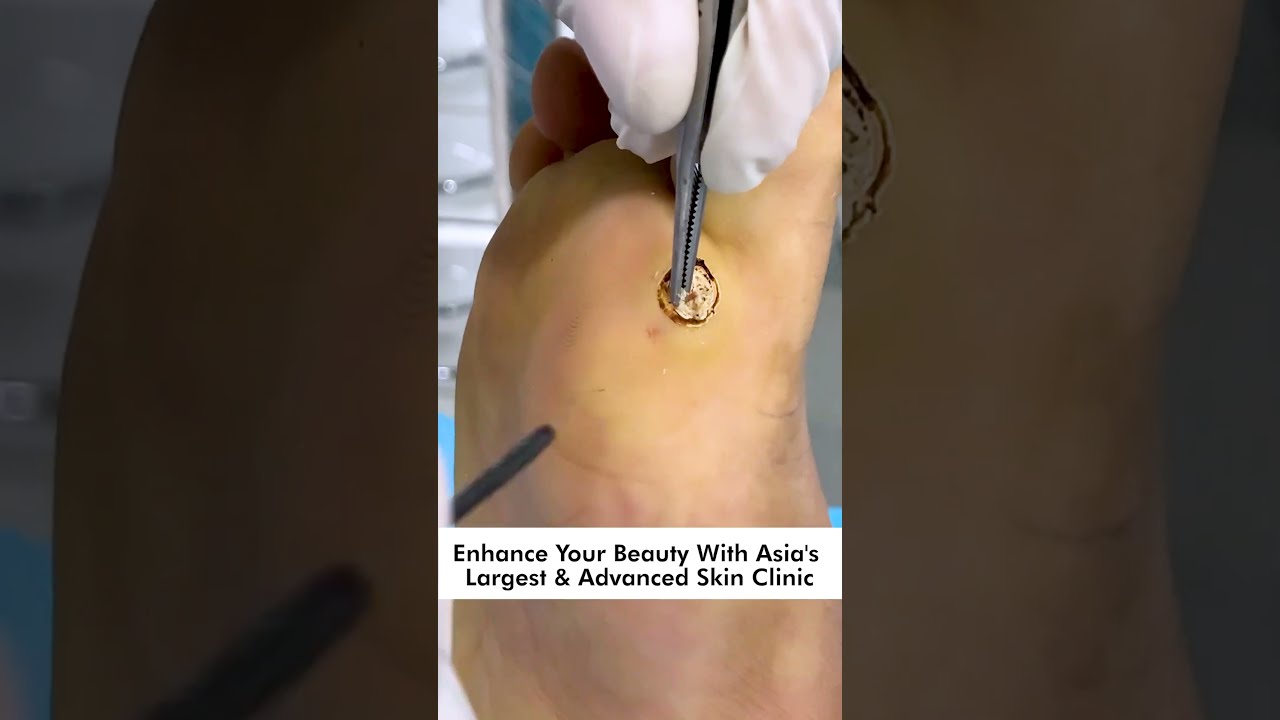 How To Remove Plantar Warts Understanding Treating And Preventing Foot Skinaa Clinic