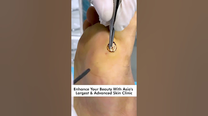 How To Remove Plantar Warts: Understanding, Treating, and Preventing Foot Warts #skinaa_clinic