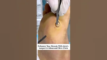 How To Remove Plantar Warts Understanding Treating And Preventing Foot Warts Skinaa Clinic 