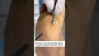 How To Remove Plantar Warts: Understanding, Treating, and Preventing Foot Warts skinaa_clinic