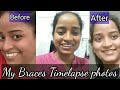 My full Braces journey Timelapse photos ,||Braces 2 years photos and Braces experience