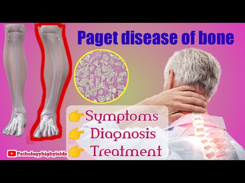 Paget Disease of Bone- What is Paget&rsquo;s disease and treatment?Key facts-usmle,neet pg, plab, fmge
