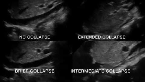 IVC Collapse Duration Classifications (No, Brief, Intermediate and Extended) by Zhou et al.
