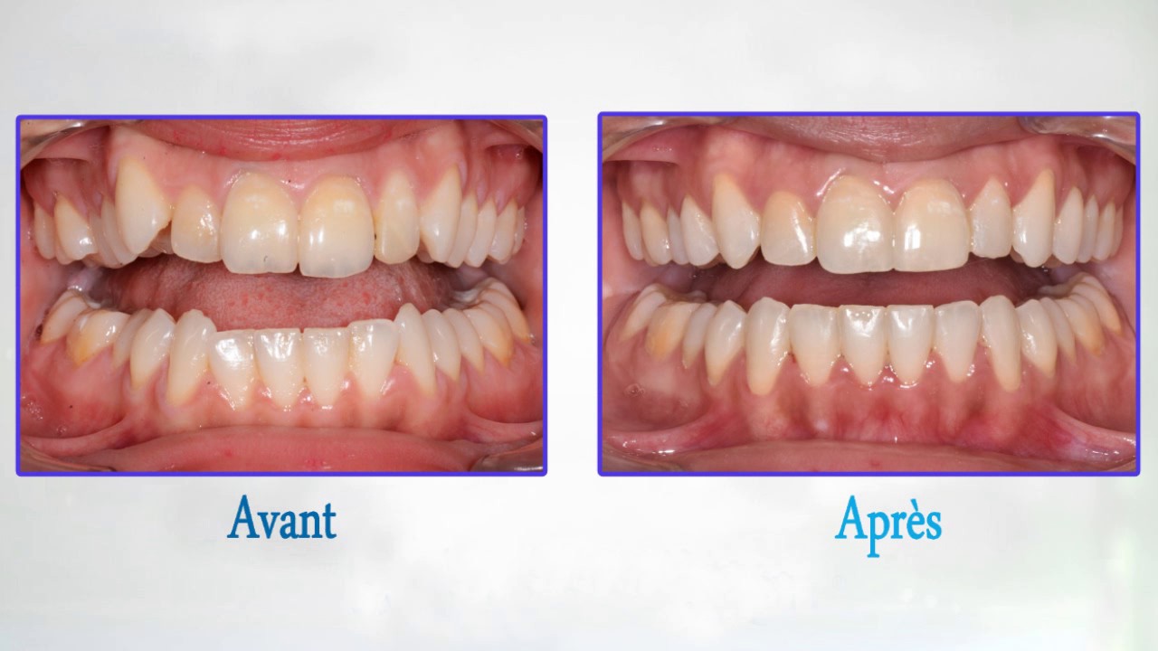 INVISALIGN TREATMENT YouTube
