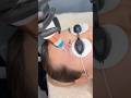 Eyebrow tattoo removal / picosecond machine
