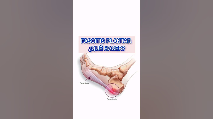 FASCITIS PLANTAR ¿QUÉ HACER?