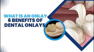 What is an Onlay: 6 Benefits of Dental Onlays