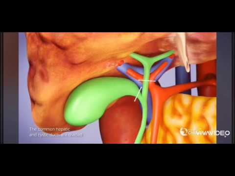 Трансплантация печени 3D.   Liver transplant 3D. Ghép gan 3D.