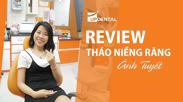 [Review niềng răng]: #95 Kết quả niềng răng của Ánh Tuyết