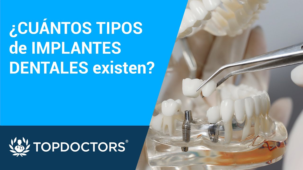 ¿CUÁNTOS TIPOS de IMPLANTES DENTALES existen?