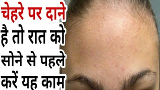 गर्मियों के दाने ठीक करने का तरीका | दाने ठीक करने के उपाय | face par dane khatam karne ka tarika screenshot 4