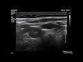 Койлинг правой внутренней сонной артерии/coiling of the right internal carotid artery