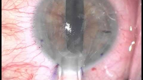 DMEK Tips and Mishaps: Guard the Gate