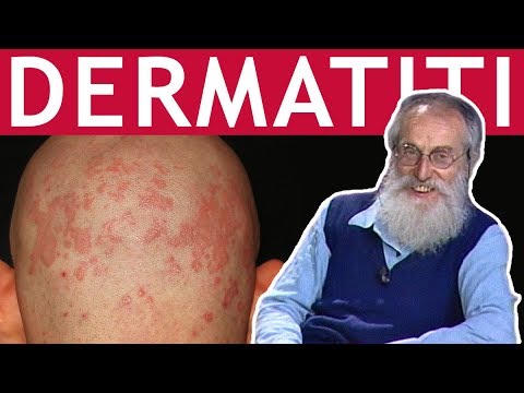 Dott. Mozzi: Dermatiti