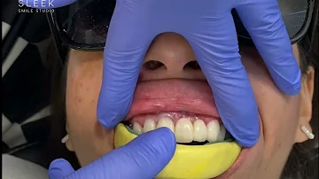 ¿Se puede hacer un puente en los dientes frontales?