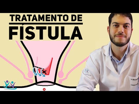 Vídeo: Fístula De Ligadura De Uma Cicatriz Pós-operatória - Sintomas E Tratamento