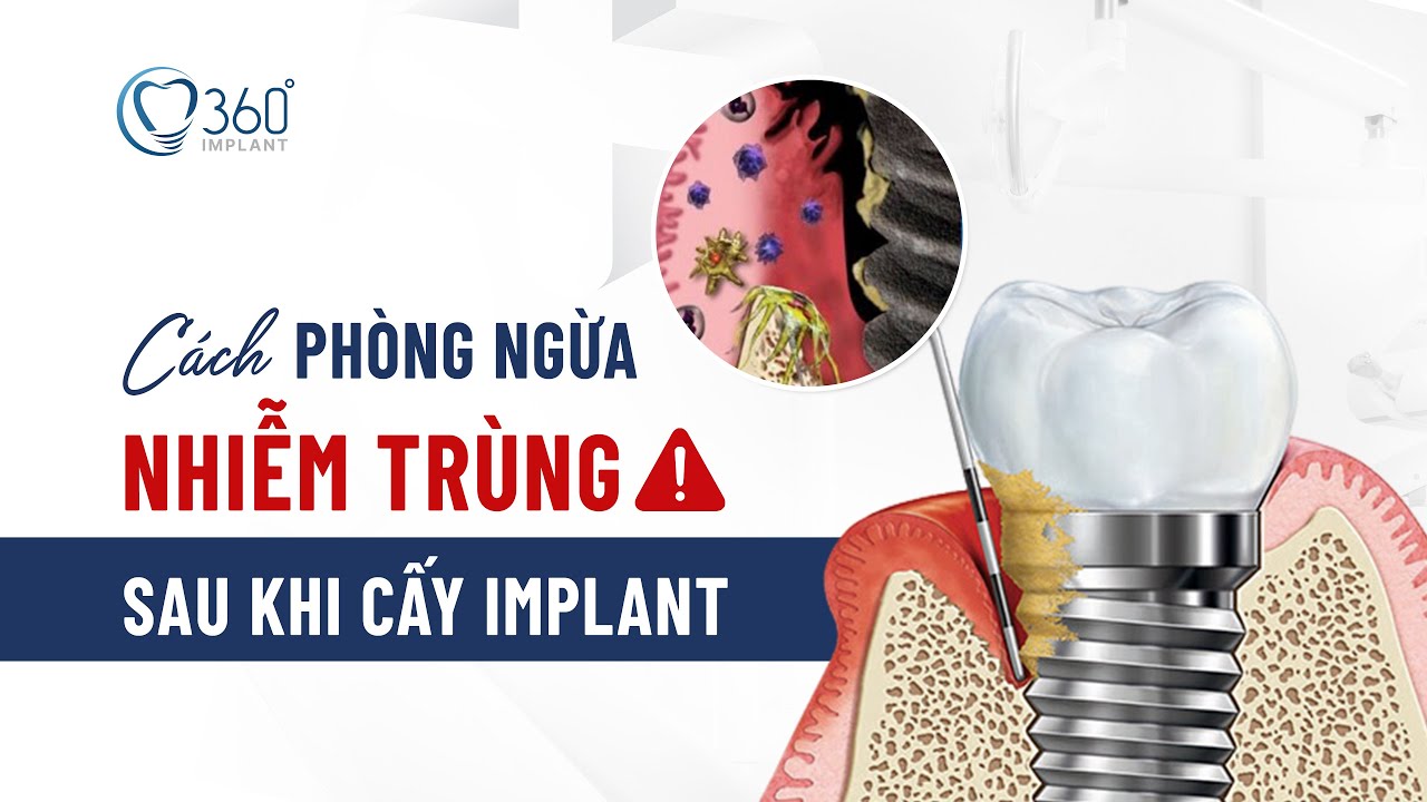 Outline Video Phòng Ngừa Nhiễm Trùng Sau Cấy Ghép Implant ThS BS Phạm Hùng Sơn