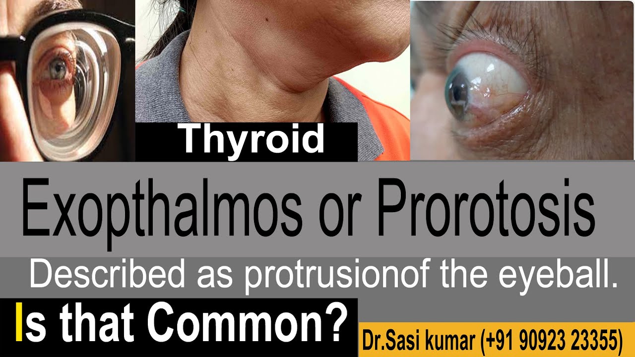 Exopthalmos or Prorotosis - Described as protrusion of the eyeball ...