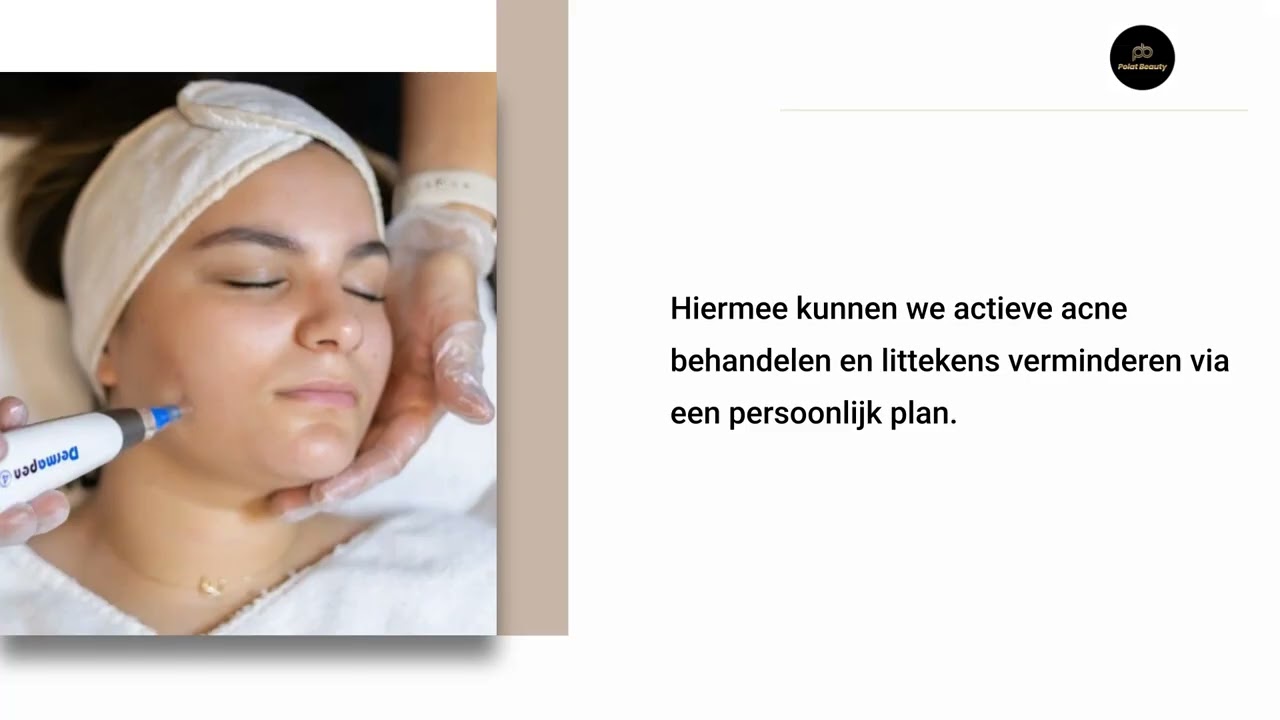 Werkt een Biopeeling ook tegen actieve acne en onzuiverheden?