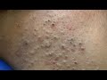 [ASMR] Morning &amp; Nighttime Skincare Routine:Pimple Treatment,Blackhead Removal &amp; Deep Pore Cleansing