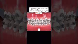 اغلب حالات التقويم وعلاجها تقدر تتخيل نتيجة اسنانك بعد التقويم 😍#السعودية #shorts #العراق