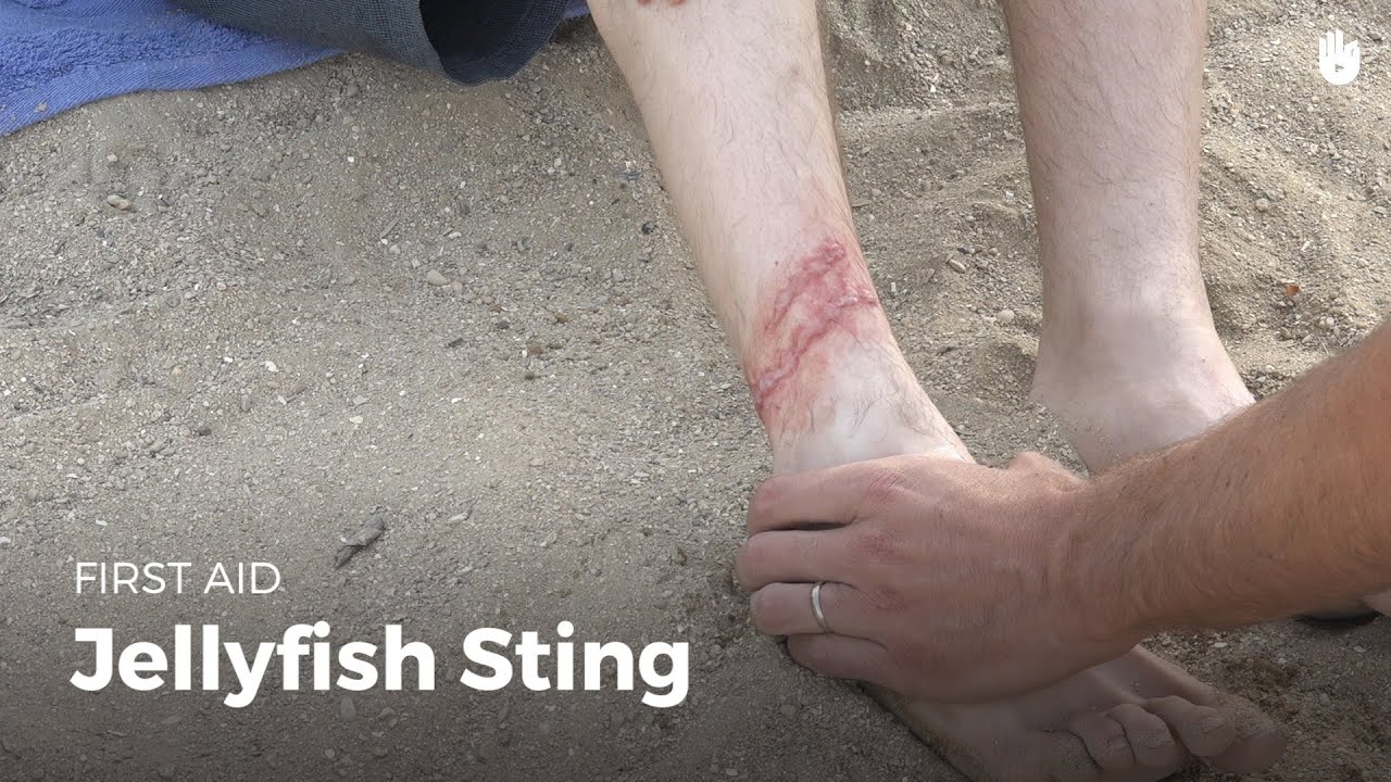 Learn First Aid Gestures: Jellyfish Sting