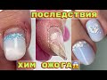 ХИМИЧЕСКИЙ ОЖОГ ч2 💅 Скрученные ногти 💅 Очень сухие руки / Manicure