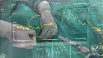 Thăm dò huyết động liên tục bằng catheter động mạch phổi thế hệ mới (PAC Swan - Ganz CCO)