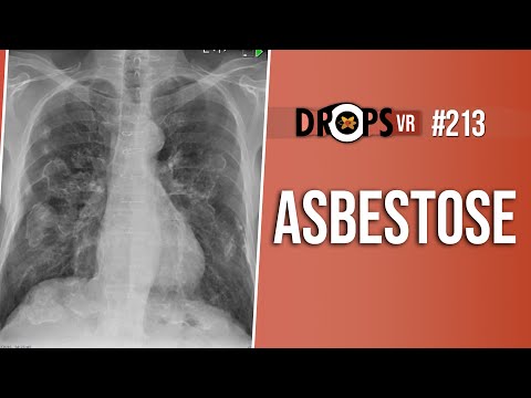 Vídeo: 4 maneiras de diagnosticar silicose