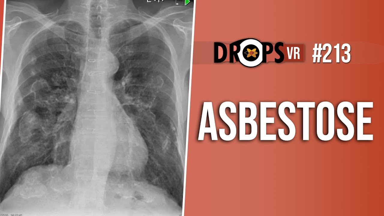 SINAIS CLÁSSICOS DA ASBESTOSE NA RADIOGRAFIA DE TÓRAX - YouTube