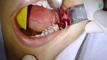 Como tirar um dente incluso?