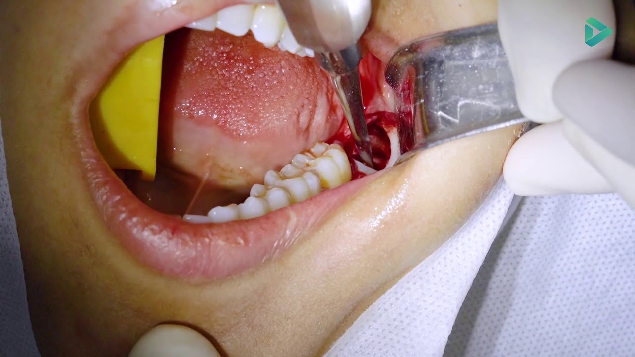 Como Limpar Os Dentes Depois De Tirar O Aparelho