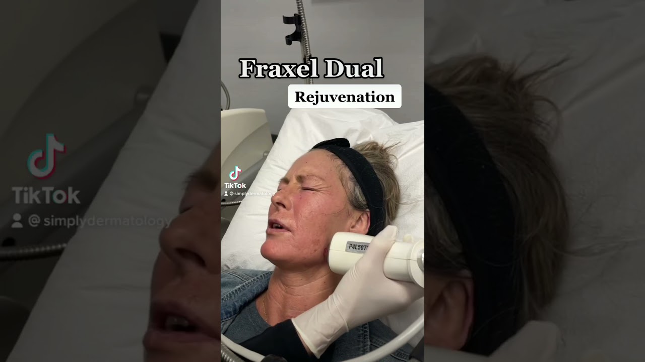 Youthful Skin | Fraxel Dual | Simply Dermatology | Dr. Papantoniou