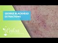 Blackheads Extractions on George