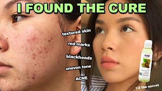 How to fix ACNE, RED MARKS &TEXTURED SKIN in 1 week (it works)