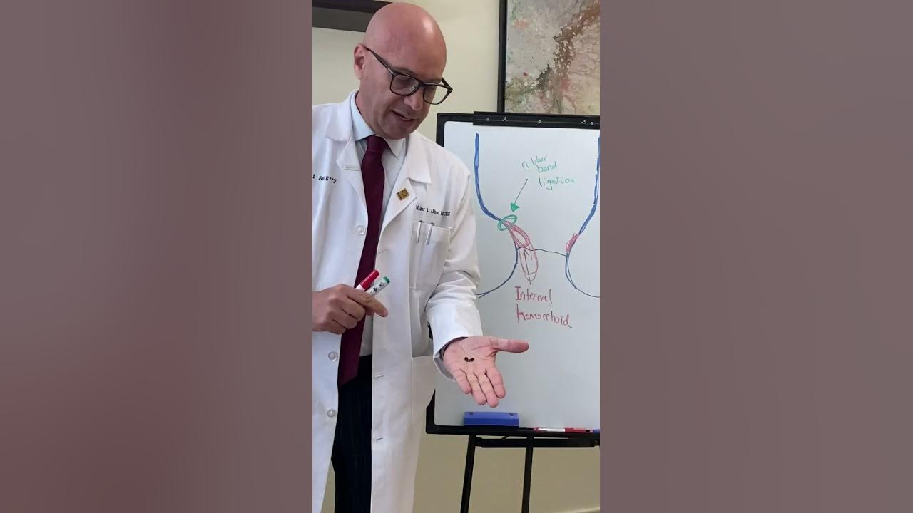 Best office based nonsurgical treatment for piles (internal