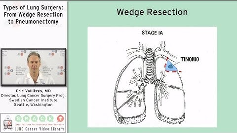 Types of Lung Surgery: From Wedge Resection to Pneumonectomy