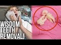 МНЕ УДАЛЯЮТ ЗУБЫ МУДРОСТИ! | Logan Paul на русском