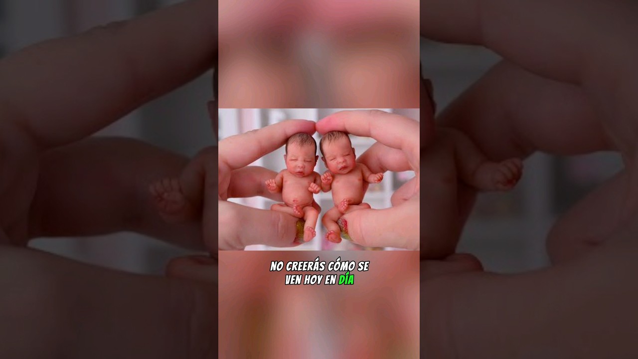 No Creerás Cómo Se Ven Hoy En Día Los Gemelos Más Pequeños Del Mundo Parte 2