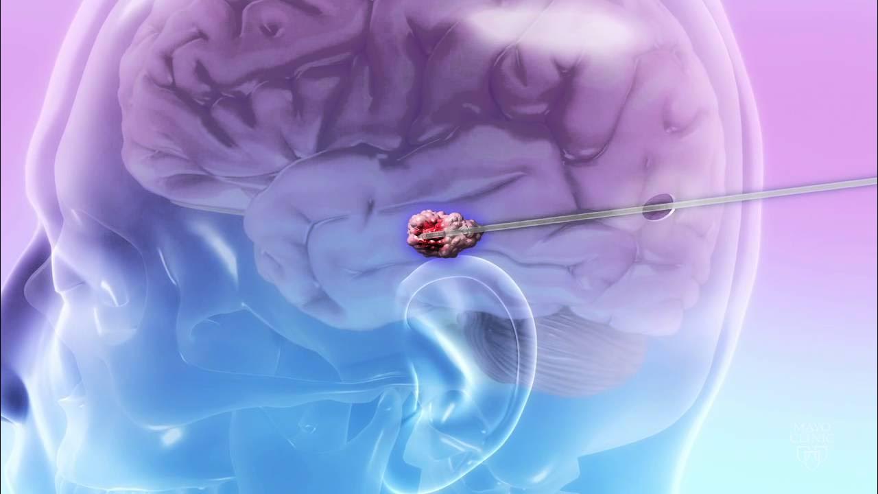 После 40 головного мозга. Электронный мозг лазеры. Опухоль головного мозга память человека.