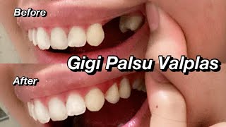 Pengalaman Pakai Gigi Palsu Lepasan Jenis Valplast / Berapa Harga dan Gimana Rasanya