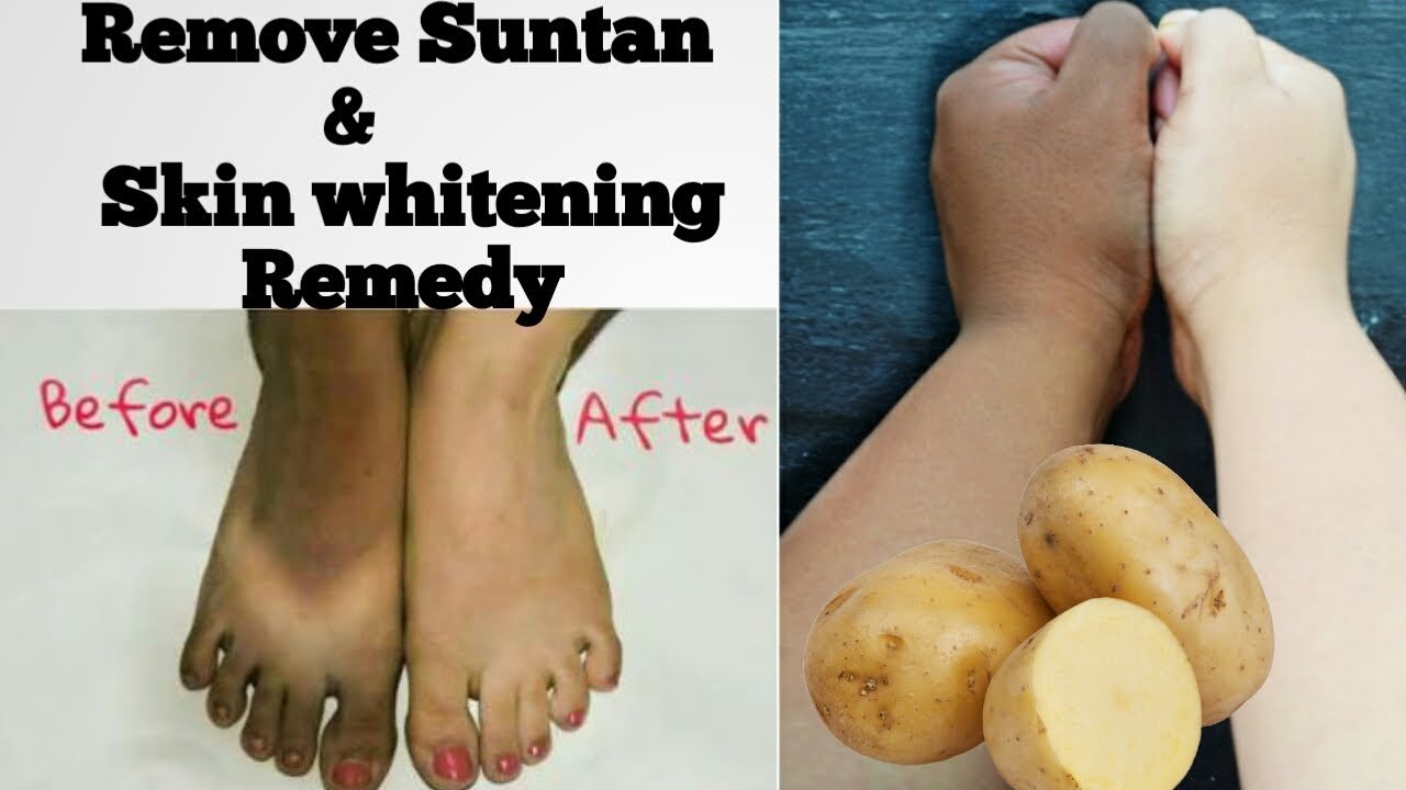 Amazing skin whitening and remove suntan remedy with potato skin