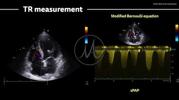 〖Echocardiography〗 Tricuspid regurgitation & sPAP