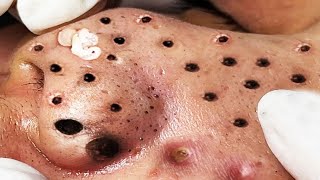 Relax Every Day With Treatment Satisfying blackhead relaxing acne, pimple, cyst by FISHING VIDEO 137 views 1 year ago 5 minutes, 5 seconds