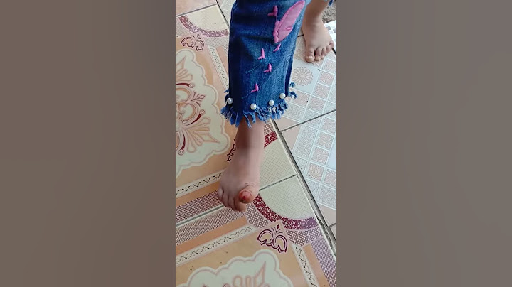 Kakinya luka jatuh dari sepeda