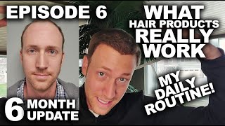 My 4 YEAR journey with hair loss (2 Hair Transplants) + Hair Loss Products Review + 6 Month Update